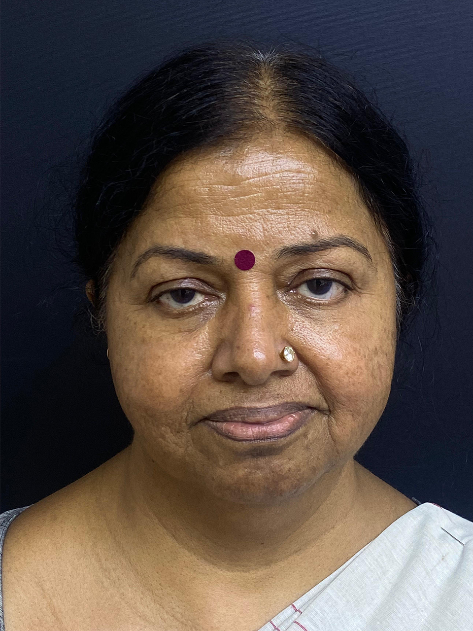 Before treatment